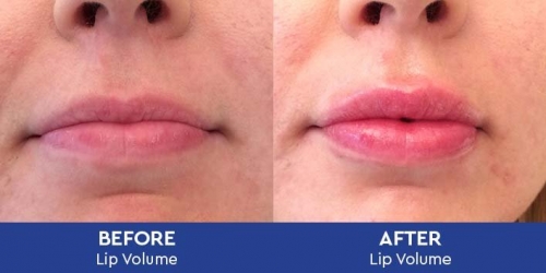 Lips+Before+and+After